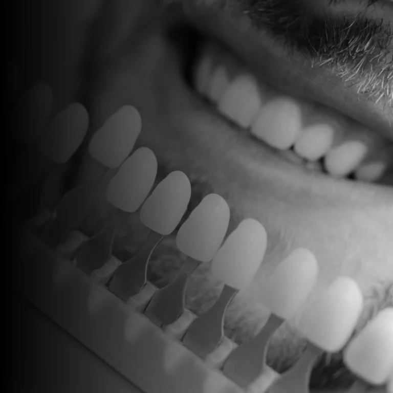 FACCETTE - faccette dentali a Milano Porta Romana